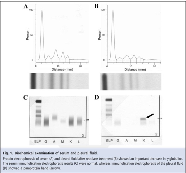 Fig 1. Biochemical examination of the serum and pleural fluid