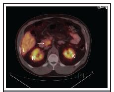 Figure 1. 68 Ga-DOTATOC PET/CT scan