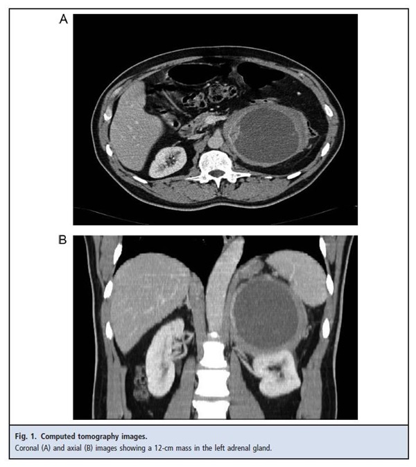 Figure 1. Computed tomography images showing a 12-cm mass on left adrenal