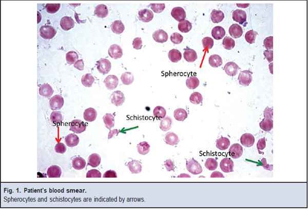 Figure 1. Patient's blood smear