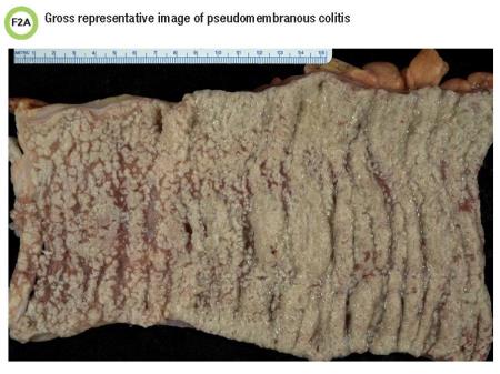 F2A Gross representative image of pseudomembranous colitis