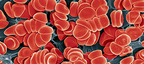 A representation of many red blood cells clumping together to illustrate blood clotting