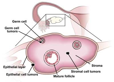 Figure 1: Ovarian Cancer Types