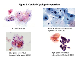 cervical cytology progression